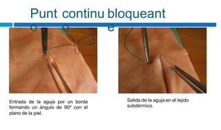 Punt
o
continu
o
bloqueant
e
Salida de la aguja en el tejido
subdérmico.
Entrada de la aguja por un borde
formando un ángulo de 90º con el
plano de la piel.
 