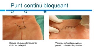 Punt
o
continu
o
bloqueant
e
Bloqueo efectuado tensionando
el hilo sobre la piel.
Visión de la herida con varios
puntos continuos bloqueantes.
 