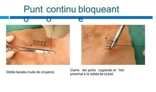 Punt
o
continu
o
bloqueant
e
Cierre del porta cogiendo el hilo
Doble lazada (nudo de cirujano).
proximal a la salida de la piel.
 