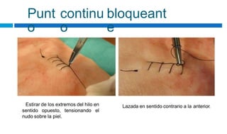Punt
o
continu
o
bloqueant
e
Estirar de los extremos del hilo en Lazada en sentido contrario a la anterior.
sentido opuesto, tensionando el
nudo sobre la piel.
 