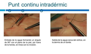 Punt
o
continu
o
intradérmic
o
Entrada de la aguja formando un ángulo
de 90º con el plano de la piel, por fuera
de la herida, en línea con la incisión.
Salida de la aguja cerca del vértice, en
la dermis de un borde.
 
