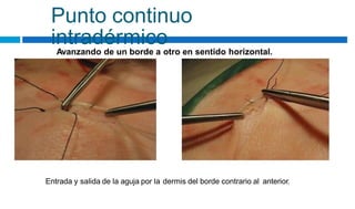 Punto continuo
intradérmico
Avanzando de un borde a otro en sentido horizontal.
Entrada y salida de la aguja por la dermis del borde contrario al anterior.
 