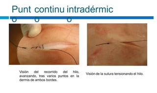 Punt
o
continu
o
intradérmic
o
Visión del recorrido del hilo,
Visión de la sutura tensionando el hilo.
avanzando, tras varios puntos en la
dermis de ambos bordes.
 