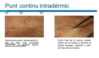 Punt
o
continu
o
intradérmic
o
Visión de la sutura, tensionando el
hilo, en fase más avanzada
Punto final de la sutura, desde
dentro de la incisión y próximo al
vértice opuesto, saliendo a piel,
en línea con la incisión.
(obsérvese la perfecta aproxi-
mación de los bordes).
 