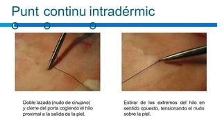 Punt
o
continu
o
intradérmic
o
Doble lazada (nudo de cirujano)
y cierre del porta cogiendo el hilo
proximal a la salida de la piel.
Estirar de los extremos del hilo en
sentido opuesto, tensionando el nudo
sobre la piel.
 