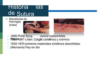 Historia
de
las
Sutura
s
 Mandíbulas de
Hormigas
(India)
1806 Philip Syng
Physik,
sutura
s
reabsorbible
s
•
•
•
•
1860-1861 Lister, Catgut carbónico y crómico
1930-1970 primeros materiales sintéticos absorbibles
(Alemania) Hoy en día
 