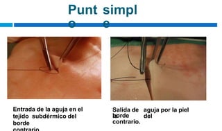 Punt
o
simpl
e
Entrada de la aguja en el
tejido subdérmico del
borde
Salida de
la
aguja por la piel
del
borde
contrario.
 