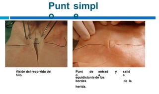 Punt
o
simpl
e
Visión del recorrido del
hilo.
Punt
o
de entrad
a
y salid
a
de la
equidistante de los
bordes
herida.
 