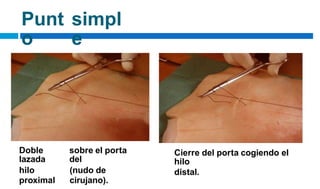 Punt
o
simpl
e
Doble
lazada
hilo
proximal
sobre el porta
del
(nudo de
cirujano).
Cierre del porta cogiendo el
hilo
distal.
 