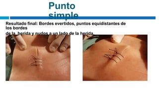 Punto
simple
Resultado final: Bordes evertidos, puntos equidistantes de
los bordes
de la herida y nudos a un lado de la herida.
 