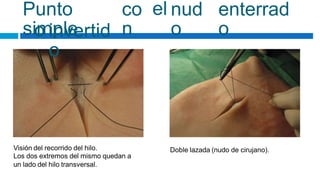 Punto
simple
co
n
el nud
o
enterrad
o
o invertid
o
Visión del recorrido del hilo.
Los dos extremos del mismo quedan a
un lado del hilo transversal.
Doble lazada (nudo de cirujano).
 