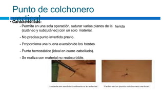 Punto de colchonero
vertical
• Características:
- Permite en una sola operación, suturar varios planos de la
(cutáneo y subcutáneo) con un solo material.
- No precisa punto invertido previo.
- Proporciona una buena eversión de los bordes.
- Punto hemostático (ideal en cuero cabelludo).
- Se realiza con material no reabsorbible.
herida
 