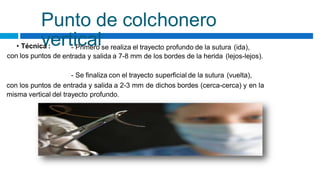 Punto de colchonero
vertical
• Técnica :
con los puntos de
- Primero se realiza el trayecto profundo de la sutura (ida),
entrada y salida a 7-8 mm de los bordes de la herida (lejos-lejos).
- Se finaliza con el trayecto superficial de la sutura (vuelta),
con los puntos de entrada y salida a 2-3 mm de dichos bordes (cerca-cerca) y en la
misma vertical del trayecto profundo.
 