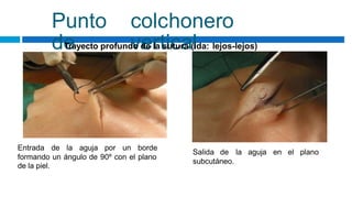 Punto
de
colchonero
vertical
Trayecto profundo de la sutura (ida: lejos-lejos)
Entrada de la aguja por un borde
Salida de la aguja en el plano
formando un ángulo de 90º con el plano
de la piel.
subcutáneo.
 