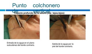 Punto
de
colchonero
vertical
Trayecto profundo de la sutura (ida: lejos-lejos)
Entrada de la aguja en el plano
subcutáneo del borde contrario.
Salida de la aguja por la
piel del borde contrario.
 
