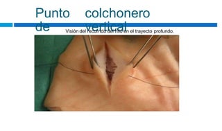 Punto
de
colchonero
vertical
Visión del recorrido del hilo en el trayecto profundo.
 