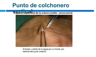 Punto de colchonero
vertical
Trayecto superficial de la sutura (vuelta: cerca-cerca)
Entrada y salida de la aguja por un borde por
delante del punto anterior.
 