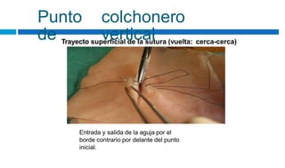 Punto
de
colchonero
vertical
Trayecto superficial de la sutura (vuelta: cerca-cerca)
Entrada y salida de la aguja por el
borde contrario por delante del punto
inicial.
 