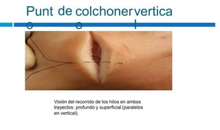 Punt
o
de colchoner
o
vertica
l
Visión del recorrido de los hilos en ambos
trayectos: profundo y superficial (paralelos
en vertical).
 