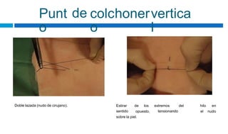 Punt
o
de colchoner
o
vertica
l
Doble lazada (nudo de cirujano). Estirar
sentido
de los extremos
tensionando
del hilo en
opuesto, el nudo
sobre la piel.
 