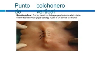 Punto
de
colchonero
vertical
Resultado final: Bordes evertidos, hilos perpendiculares a la incisión,
con el doble trayecto (lejos-cerca) y nudos a un lado de la misma.
 