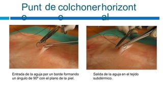 Punt
o
de colchoner
o
horizont
al
Entrada de la aguja por un borde formando
un ángulo de 90º con el plano de la piel.
Salida de la aguja en el tejido
subdérmico.
 