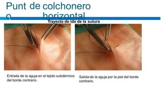 Punt
o
de colchonero
horizontal
Trayecto de ida de la sutura
Entrada de la aguja en el tejido subdérmico Salida de la aguja por la piel del borde
contrario.
del borde contrario.
 