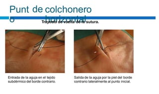 Punt
o
de colchonero
horizontal
Trayecto de vuelta de la sutura.
Entrada de la aguja en el tejido
subdérmico del borde contrario.
Salida de la aguja por la piel del borde
contrario lateralmente al punto inicial.
 