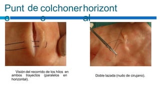 Punt
o
de colchoner
o
horizont
al
Visión del recorrido de los hilos en
ambos trayectos (paralelos en
horizontal).
Doble lazada (nudo de cirujano).
 