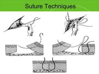 Suture Techniques Simple Interrupted Used on majority of wounds Each stitch is independent 