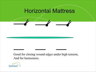 Horizontal Mattress Good for closing wound edges under high tension, And for hemostasis. 