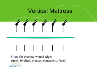 Vertical Mattress Good for everting wound edges  (neck, forehead creases, concave surfaces) 