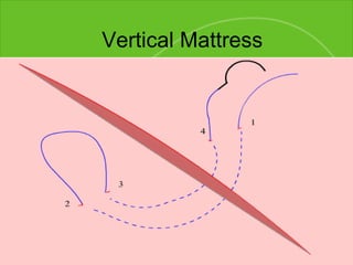 Vertical Mattress 