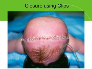 Closure using Clips 