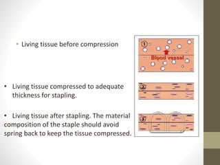 • Living tissue before compression
• Living tissue compressed to adequate
thickness for stapling.
• Living tissue after stapling. The material
composition of the staple should avoid
spring back to keep the tissue compressed.
 