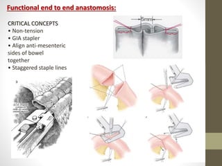 Functional end to end anastomosis:
CRITICAL CONCEPTS
• Non-tension
• GIA stapler
• Align anti-mesenteric
sides of bowel
together
• Staggered staple lines
 