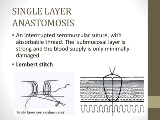 SINGLE LAYER
ANASTOMOSIS
• An interrrupted seromuscular suture, with
absorbable thread. The submucosal layer is
strong and the blood supply is only minimally
damaged
• Lembert stitch
 