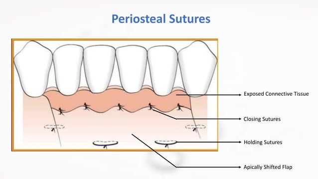 Dental Suturing: materials and techniques. | PPTX | First Aid | Injuries