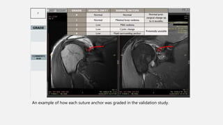 An example of how each suture anchor was graded in the validation study.
 