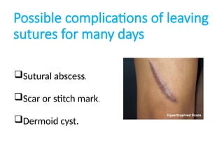 SUTURE AND SUTURING TECHNIQUES IN SURGERY | PPTX