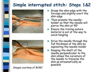 Simple interrupted stitch: Steps 1&2
 Grasp the skin edge with the
forceps and slightly evert the
skin edge
 Then pronate the needle-
holder so that the needle will
pierce the skin at 90o
 Ensure the trailing suture
material is out of the way to
avoid tangling
 Drive the needle through the
full thickness of the skin by
supinating the needle-holder
 Keeping the shaft of the
needle perpendicular to the
skin allows the curvature of
the needle to traverse the
skin as atraumatically as
possible
Images courtesy of BUMC
 