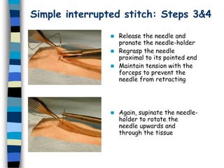 Simple interrupted stitch: Steps 3&4
 Release the needle and
pronate the needle-holder
 Regrasp the needle
proximal to its pointed end
 Maintain tension with the
forceps to prevent the
needle from retracting
 Again, supinate the needle-
holder to rotate the
needle upwards and
through the tissue
 