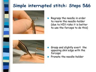 Simple interrupted stitch: Steps 5&6
 Regrasp the needle in order
to rearm the needle-holder
(due to HIV risks it is better
to use the forceps to do this)
 Grasp and slightly evert the
opposing skin edge with the
forceps
 Pronate the needle-holder
 