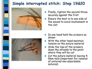 Simple interrupted stitch: Step 19&20
 Finally, tighten the second throw
securely against the first
 Ensure the knot is to one side of
the wound to avoid involvement in
the clot
 In one hand hold the scissors as
shown
 With the other hand maintain
tension on the suture material
 Slide the tips of the scissors
down the strands to the point
where they will be cut
 Cut the suture material leaving 4-
5mm tails (important for removal
of external non-absorbable
sutures)
 