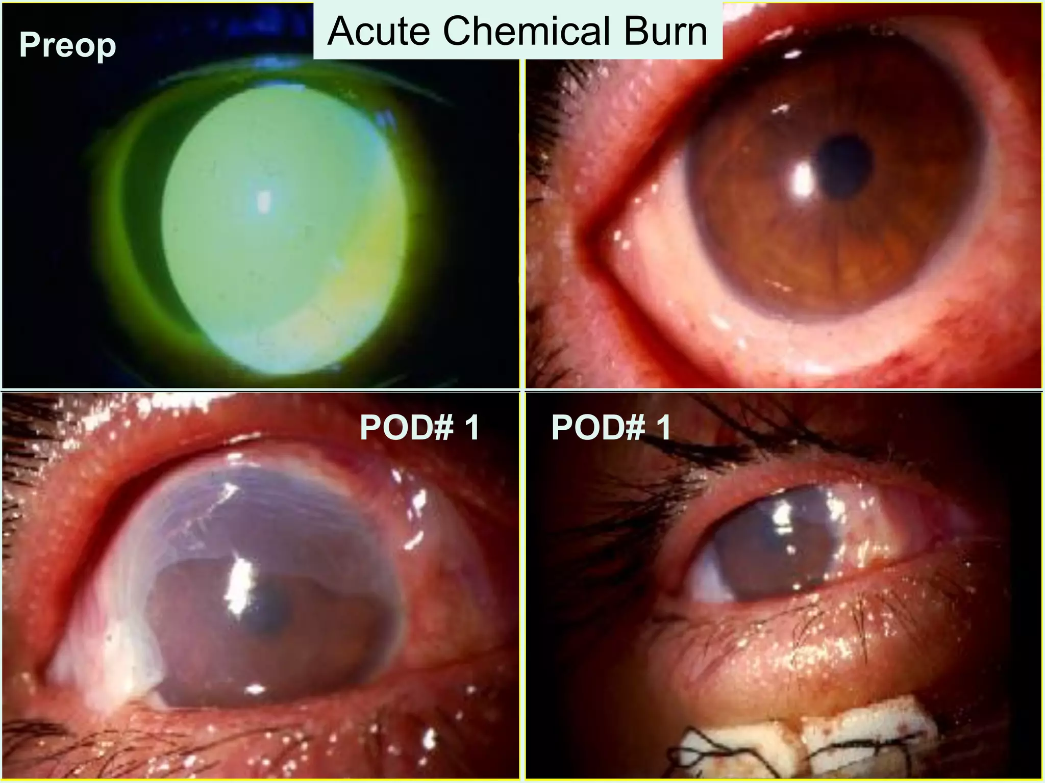 Preop
POD# 1 POD# 1
Acute Chemical Burn
 