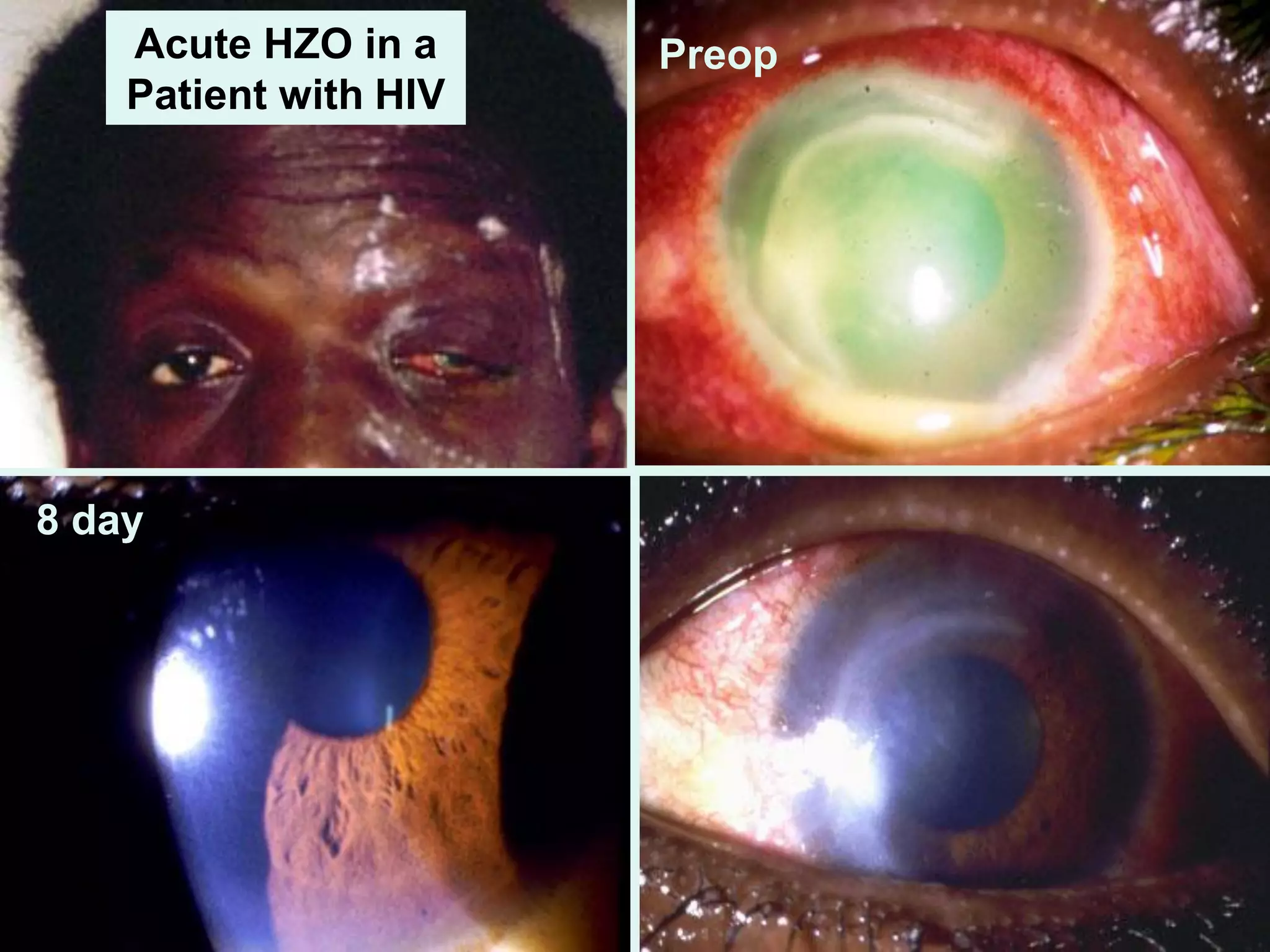 Acute HZO in a
Patient with HIV
Preop
8 day
 