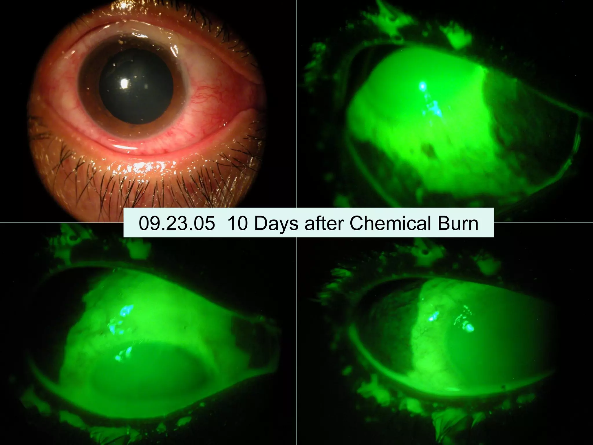 09.23.05 10 Days after Chemical Burn
 