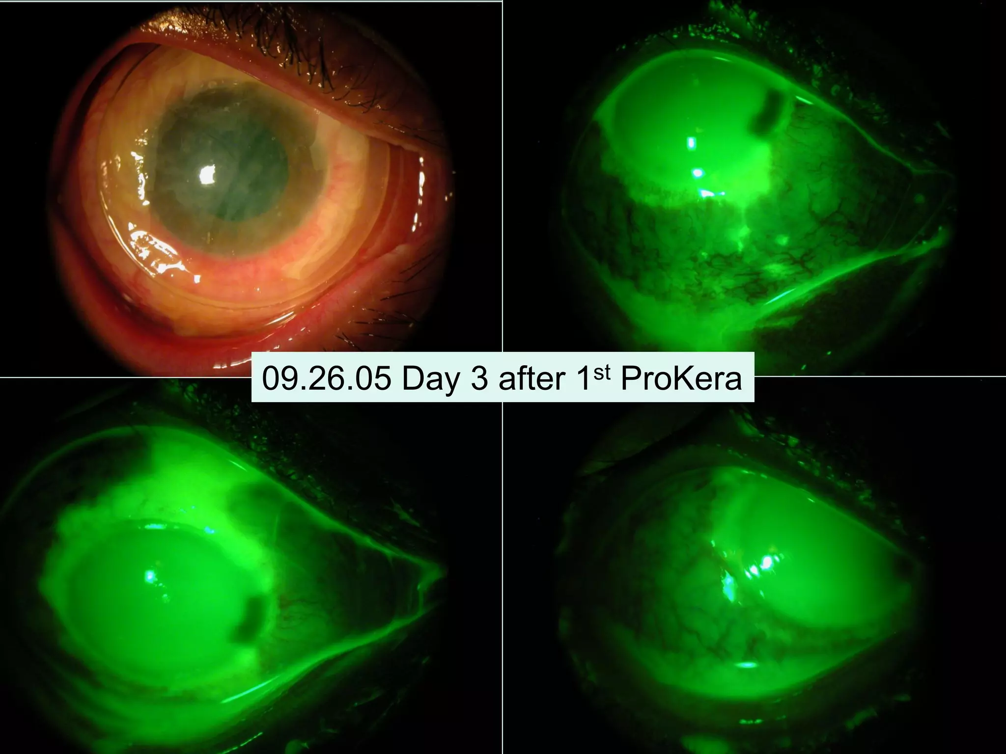 09.26.05 Day 3 after 1st ProKera
 