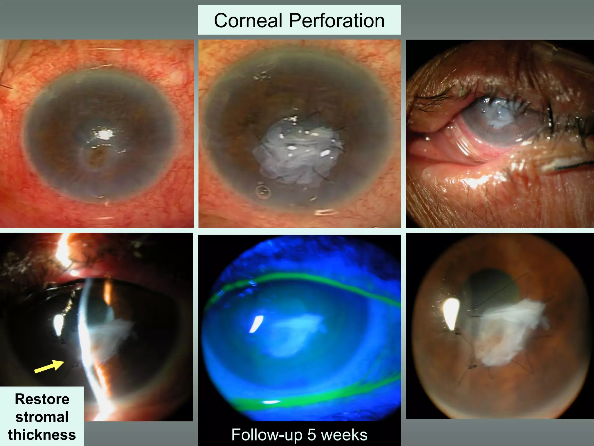 Follow-up 5 weeks
Corneal Perforation
Restore
stromal
thickness
 