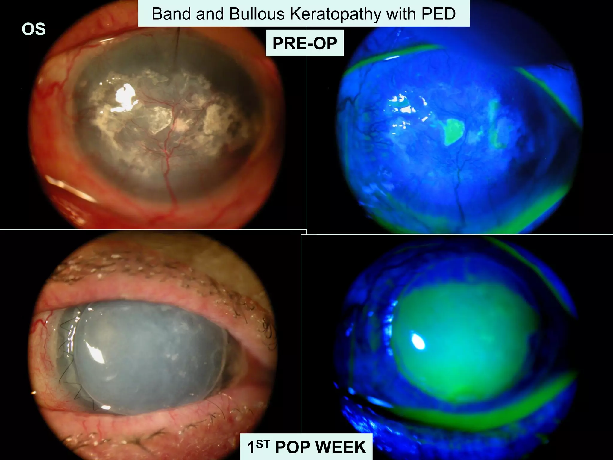 OS
PRE-OP
Band and Bullous Keratopathy with PED
1ST POP WEEK
 